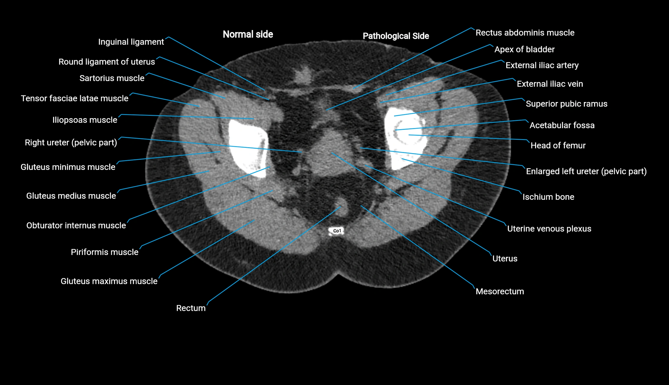 CT KUB axial cross sectional anatomy  radiology image -img-00201-00151.webp